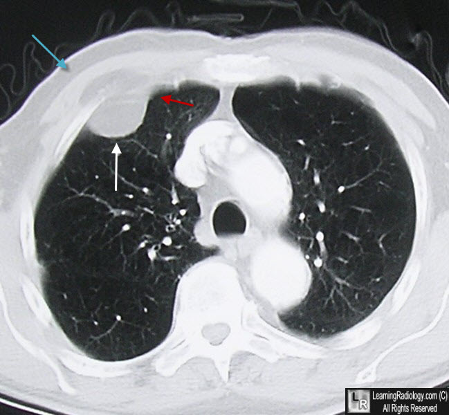 extrapleural lipoma